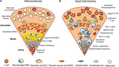 Aging-Related Vascular Inflammation: Giant Cell Arteritis and Neurological Disorders